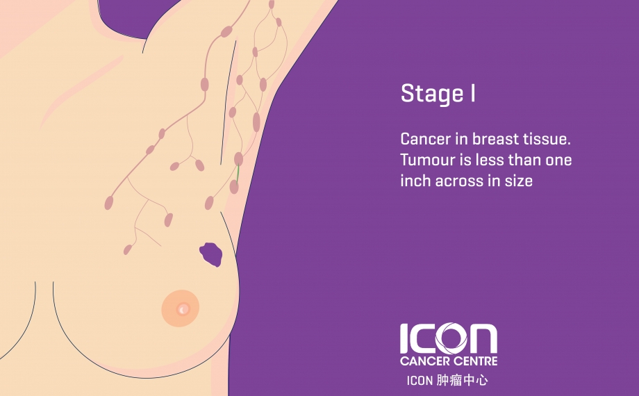 What is Breast Cancer? Symptoms & Causes - ICON Cancer Center (China)