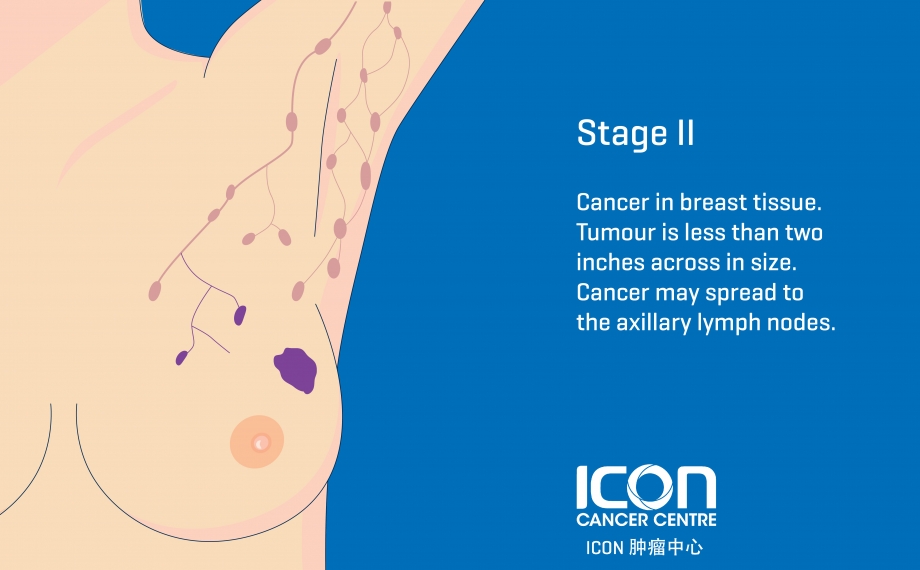 What is Breast Cancer? Symptoms & Causes - ICON Cancer Center (China)