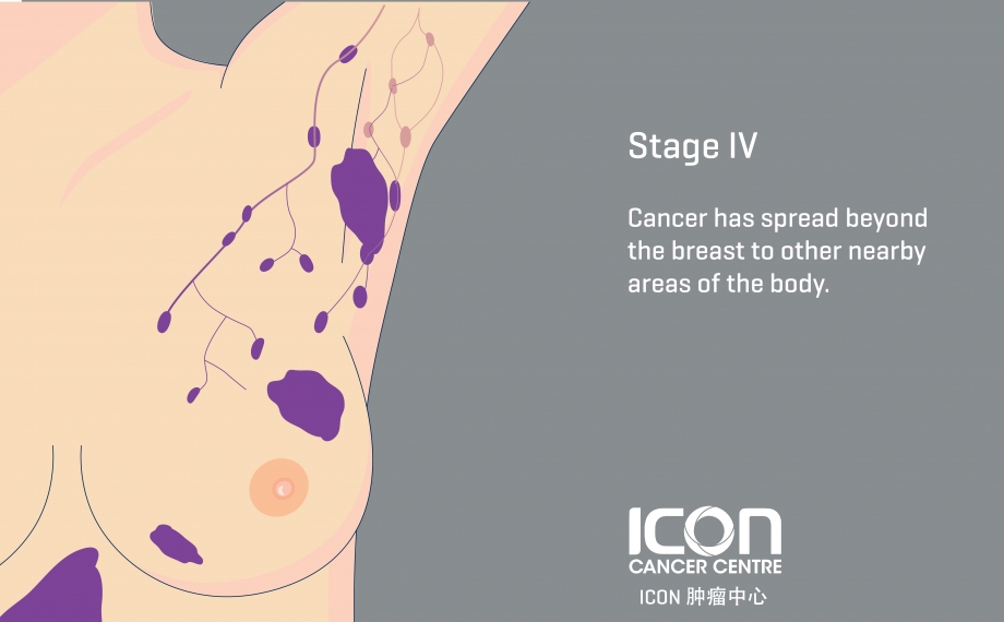 Breast Cancer - Symptoms & Causes