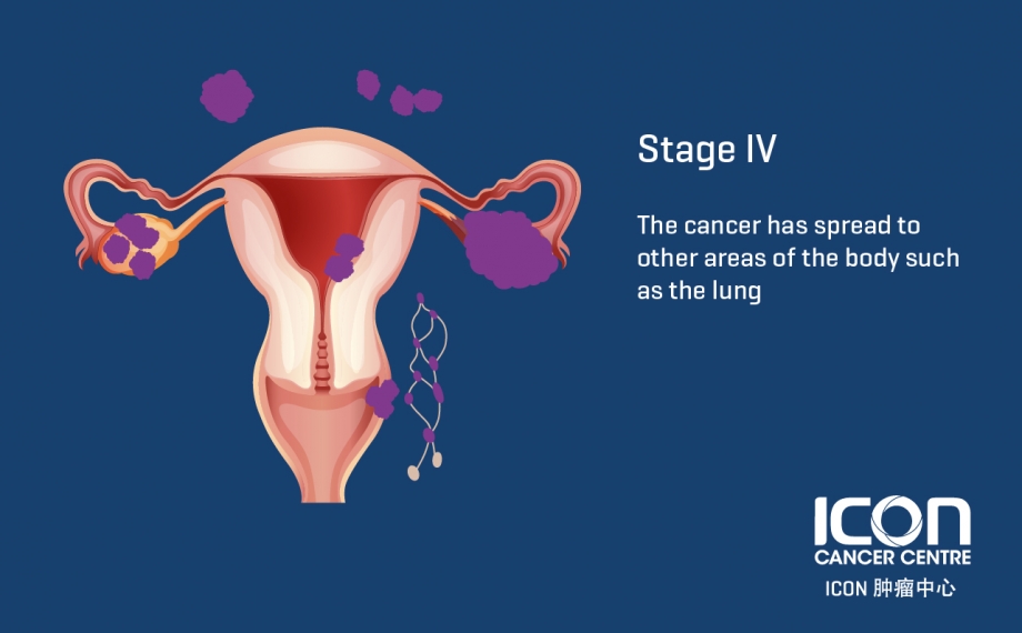 What Is Stage 4 Ovarian Cancer Mean