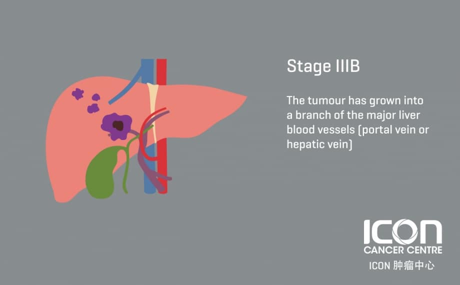 stages of liver cancer
